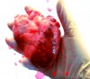 Balle anti-stress chirurgie cardiaque.gif