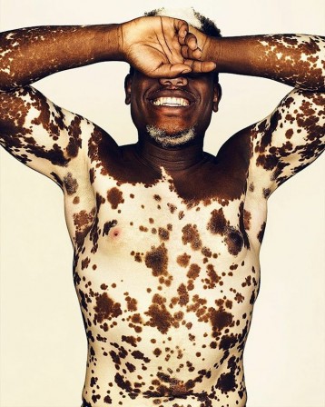 peau_vitiligo.jpg