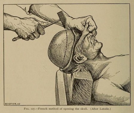 autopsie méthode française d'ouverture du crâne.jpg