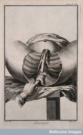 Examination of the perineum is an 18th century anatomical drawing by A. J. Defehrt after Louis-Jacques Goussier question lever le doigt.jpg, déc. 2020