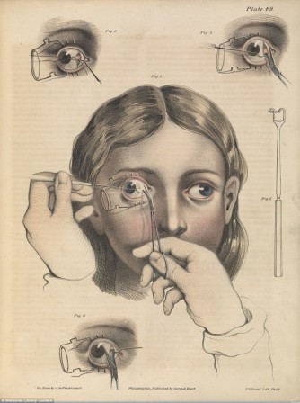 Picture from an 1846 textbook shows eye surgery to correct ‘strabismus’, a misalignment of the eyes known as a squint strabisme lutter contre la tentation de l'extrême droite.jpg, avr. 2021