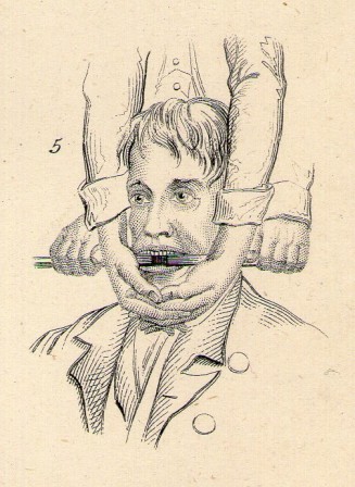 detail from a series of illustrations of dislocation from a later 19th century encyclopaedia c1880 Ostéopathe luxations et réductions rendre le sourire.jpg, nov. 2020