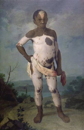 Joaquim Manuel da Rocha portrait de Siriaco 1786 vitiligo