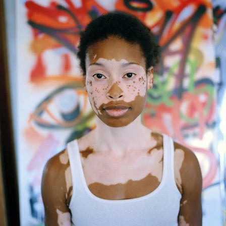 vitiligo_beaute.jpg