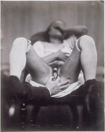 Felix Nadar ~ Examination of a hermaphrodite,c.1860.jpg, oct. 2020