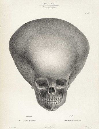 Joseph Vimont and Engelman - Skull of a Hydrocephalic Child, from Traité de Phrénologie Humaine et Comparée, 1832 si tu veux devenir intelligent comme papa il faut bien travailler à l'école.jpg, sept. 2020