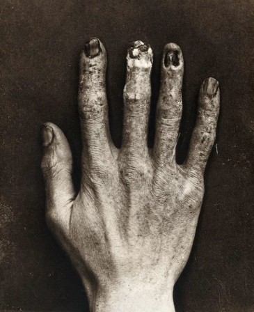 The hand of an x-ray technician at the Royal London Hospital showing damage from radiation exposure ca. 1900.jpg, déc. 2020
