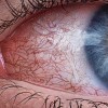 les vaisseaux rouges dans le blanc de l'oeil d'une femme dessinent une vie injectée de sang